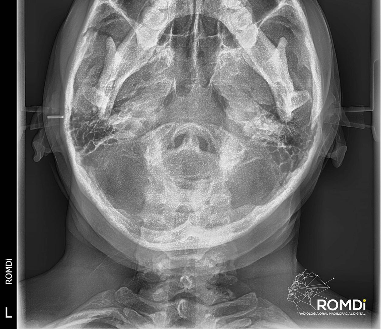 Radiografía AP de cráneo